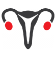 Ovarian Cancer